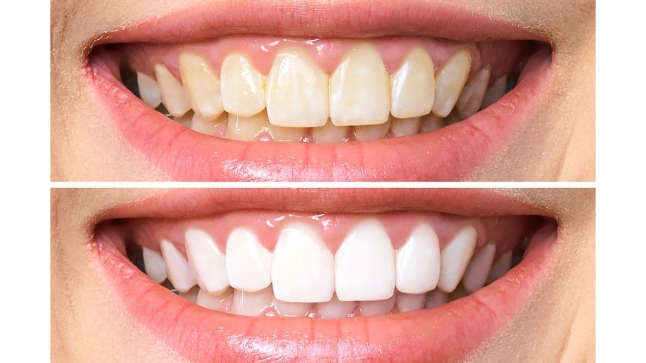 clareamento-dental-em-casa